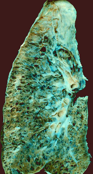 Pulmón afectado de fibrosis
